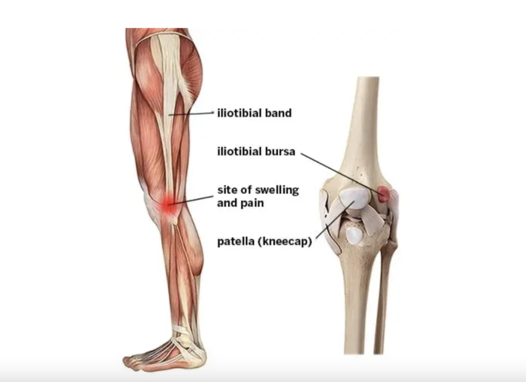 I’m a Cyclist and Physical Therapist, and When I Identified This Pain On the Outside of My Knee, I Did This - 303Endurance